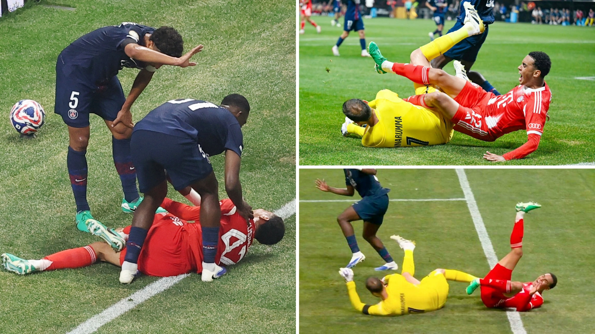 官方：穆西亚拉腓骨骨折且踝关节脱臼将接受手术治疗的简单介绍  第2张